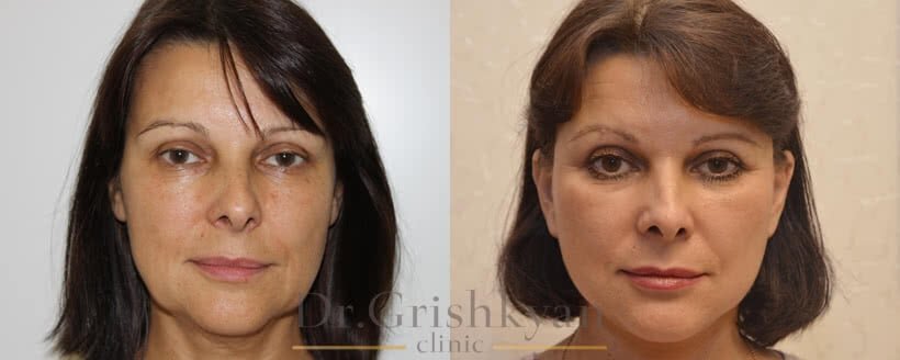 Подтяжка лица SMAS фото до и после. Фото с сайта Д.Р. Гришкяна. Имеются противопоказания, требуется консультация специалиста