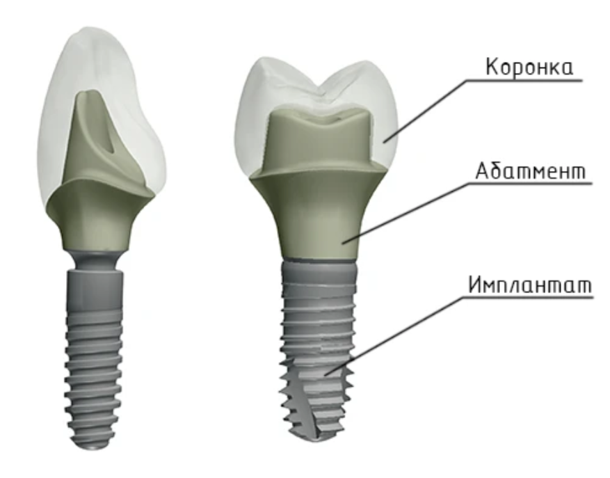 Имплантация основы. Структура дентального имплантат. Имплант зуба абатмент. Абатмент на зубной имплант. Имплант винт абатмент коронка.