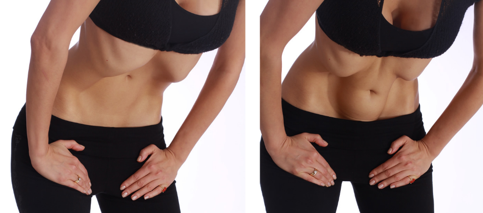 Выделение прямой мышцы живота