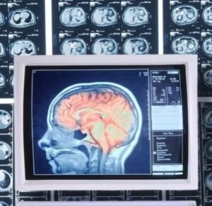 [caption id="attachment_834" align="aligncenter" width="300"] Как выглядит недуг на снимке[/caption]