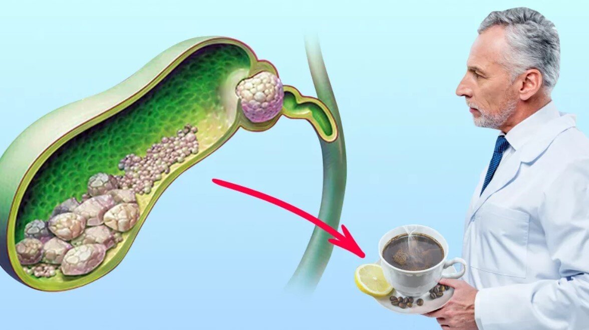 Желчь плохо. Застой желчи в желчном пузыре. Стаз желчи в желчном пузыре. Застой и камни в желчном пузыре. Застой в желчном пузыре таблетки.