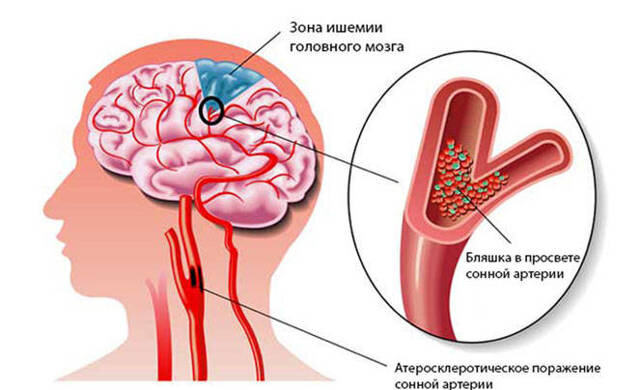 Гемипарез после инсульта