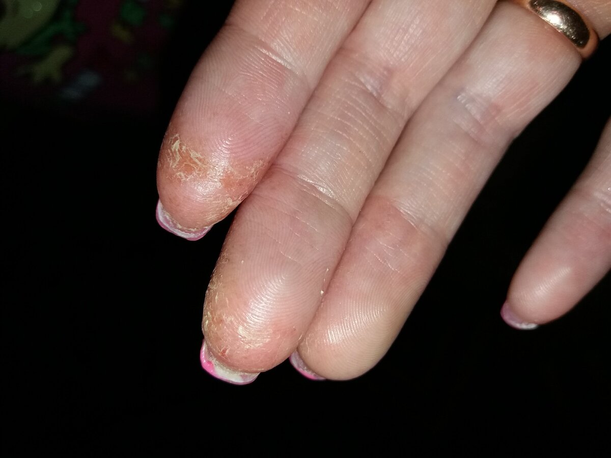 Аллергия на пальцах от средств для маникюра