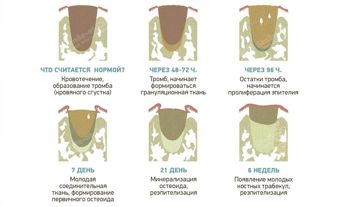 Как выглядит лунка после удаления зуба на 4 день фото