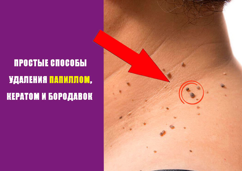 Простые способы удаления папиллом, кератом и бородавок