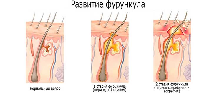 Лечение отита