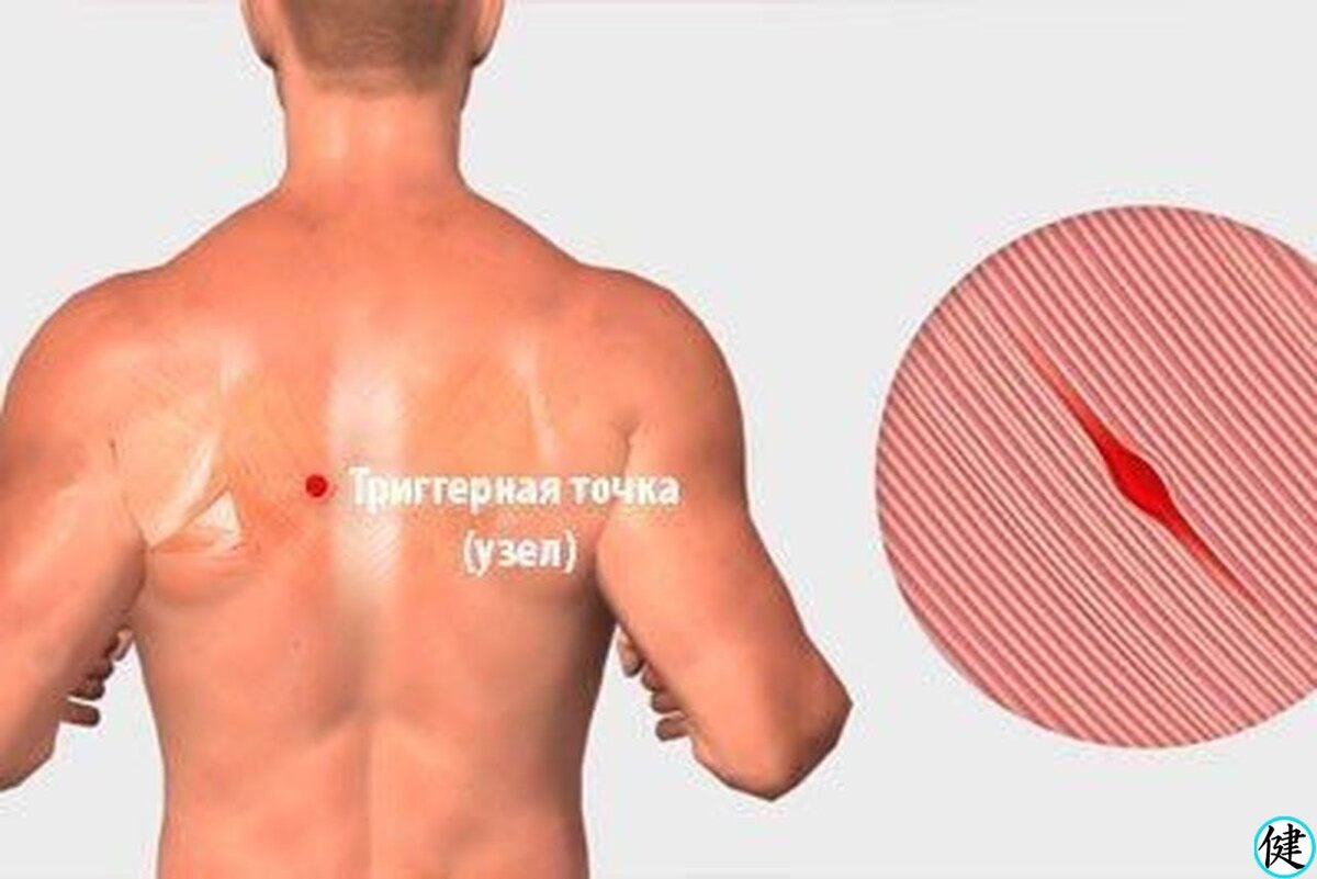 Миофасциальные триггерные точки шеи