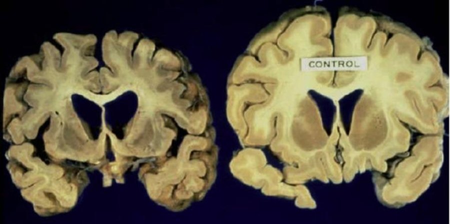 Прион: развитие болезни. Слева пораженный мозг, справа здоровый