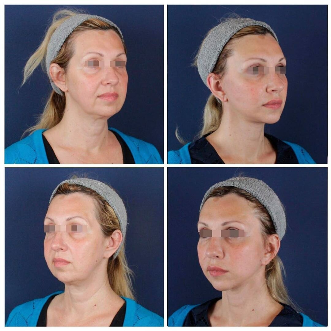 Женщины 40+ до и после подтяжки лица: разбор фото реальных пациентов |  TecRussia.ru | Дзен