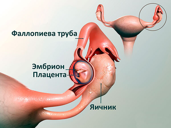 Внематочная беременность: симптомы, диагностика, лечение