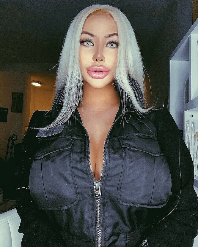 Самые большие губы в мире: 8 девушек, изуродовавших себя филлерами