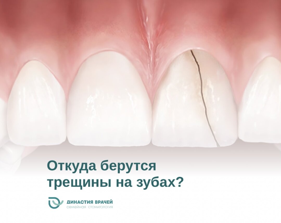 Откуда трещина. Причины возникновения трещин на эмали. От чего может быть трещина на зубе. От чего могут появиться трещины на зубах.