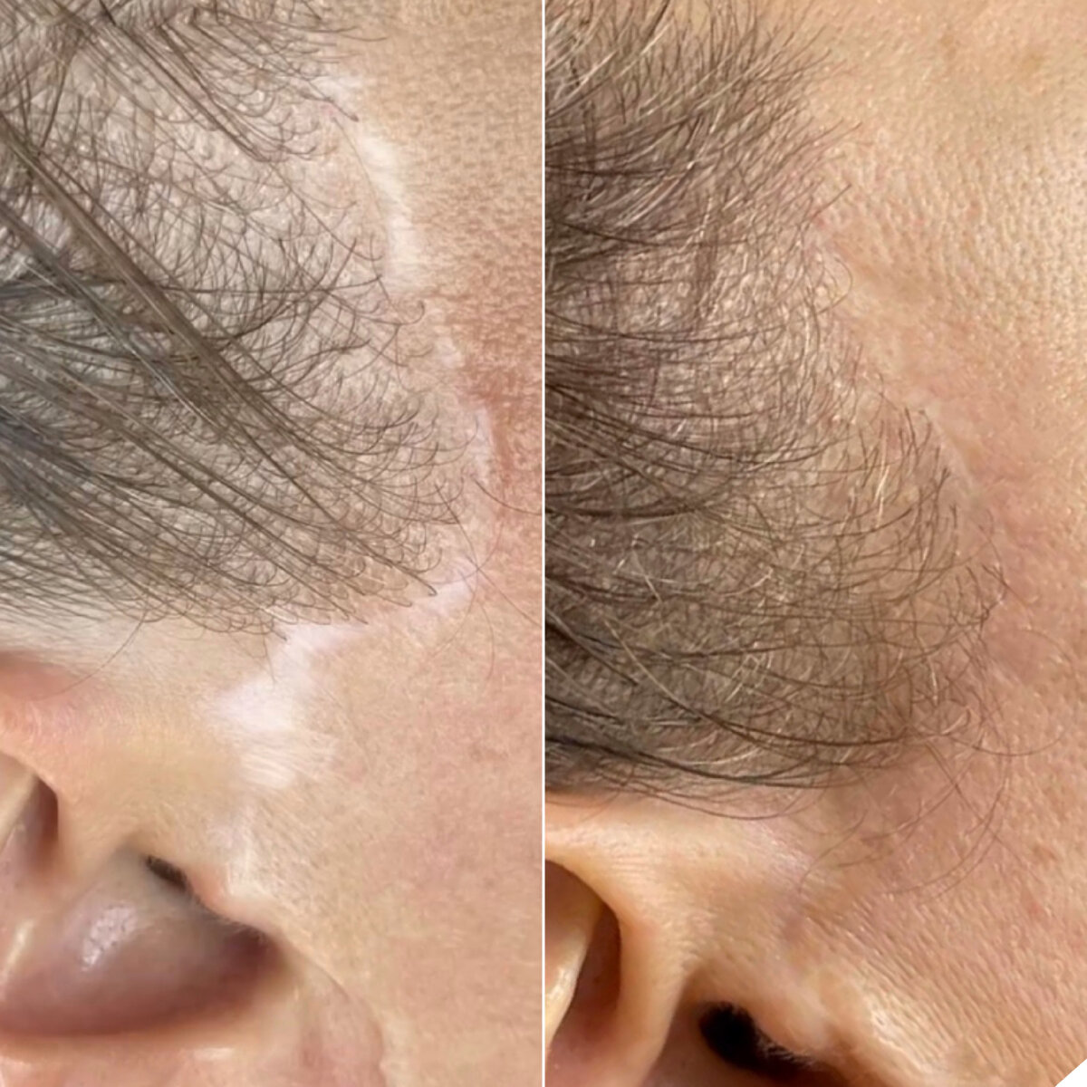 Камуфляж шрама после подтяжки 