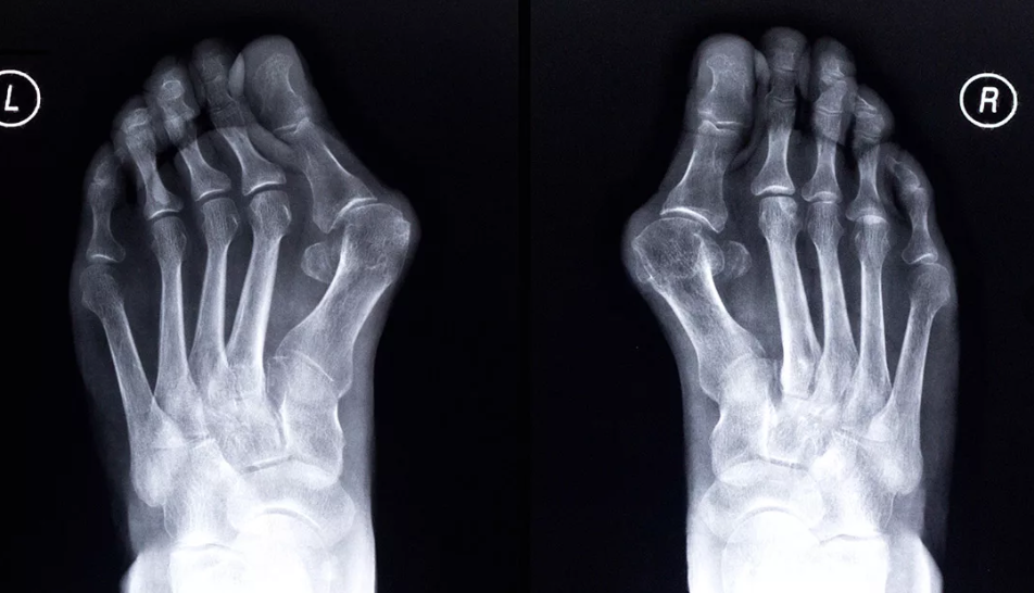 Деформация пальцев стопы мкб. Рентген стопы халюс вальгус. Халюкс вальгус рентген. Халлюкс вальгус стопы рентген.