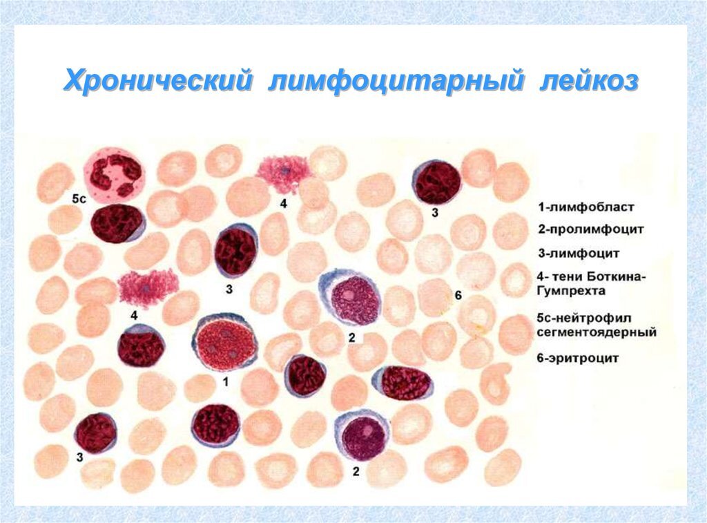 Картина крови при хроническом миелолейкозе