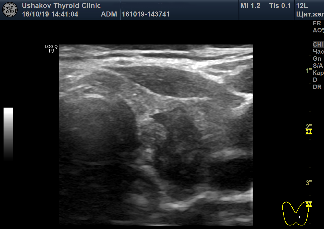 В правой доле гипоэхогенное образование. Гипоэхогенное образование на лбу. Н/З гипоэхогенный узел. Гипоэхогенное образование в Вене. Узел щитовидки разделился гипоэхогенной полосой.