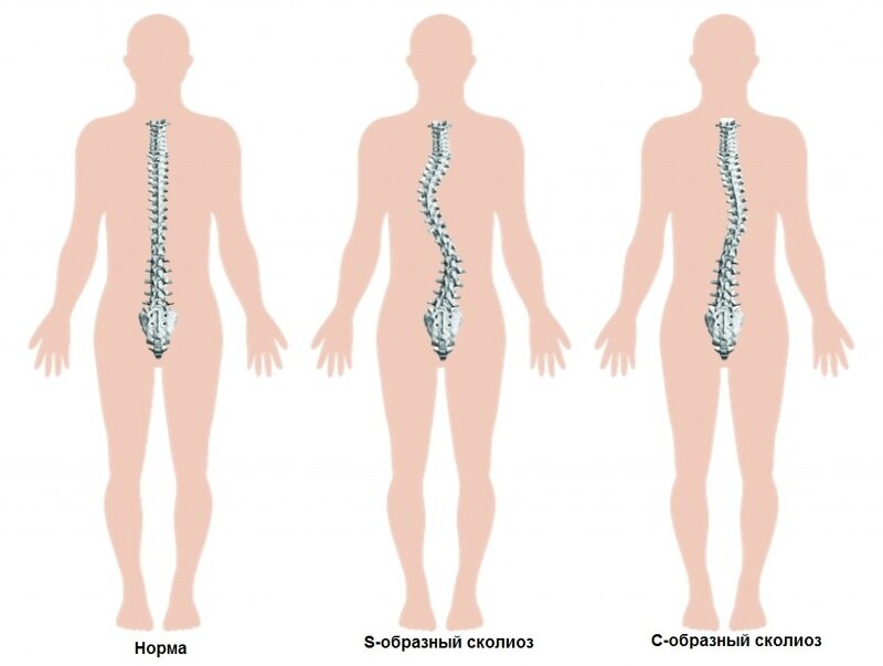 По локализации сколиоз разделяется на:
грудной;
грудо-поясничный;
поясничный;
пояснично-крестцовый;
комбинированный.