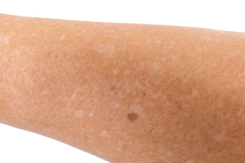 Белые пятна на коже: причины появления, способы лечения - FitoMarket