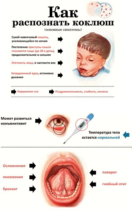 Коклюш: возбудитель, симптомы, лечение, профилактика