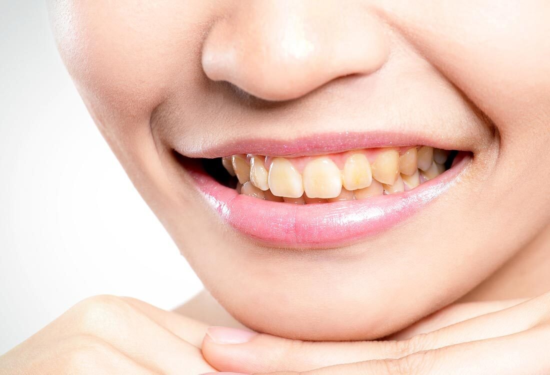   Многие люди страдают оттого, что у них желтый цвет зубов. Тем более что принято считать — это признак больных зубов.  На самом же деле с желтыми зубами, как и с карими глазами, люди, бывает, рождаются. Что интересно, желтоватая эмаль прочнее белой. И отбеливать ее, по мнению некоторых стоматологов, — преступление. 
Можно отбелить зубы, потемневшие от курения или кофе. Причем ряд специалистов считает, что достичь этого можно с помощью зубных паст, другие же уверены, что помочь могут только спецсредства в клинике. Однако подобная операция ослабляет и нередко разрушает эмаль, что приводит к развитию кариеса. 
Надо отметить, что, по мнению некоторых стоматологов, людей с чисто белыми зубами не существует в природе. С рождения зубы либо желтоватые, либо серо-голубые, а снежнозубые красотки из рекламы сверкают накладками или протезами.