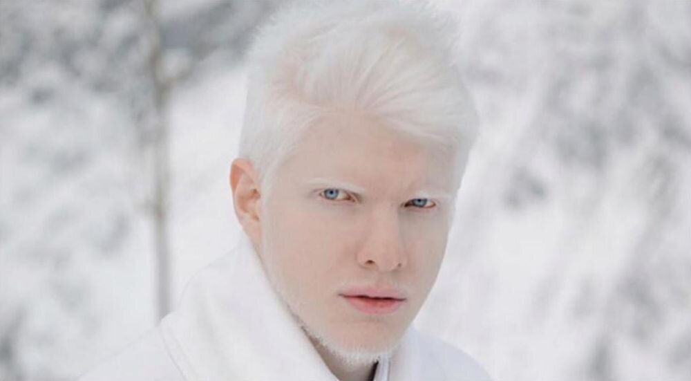 Альбинос человек фото мужчины