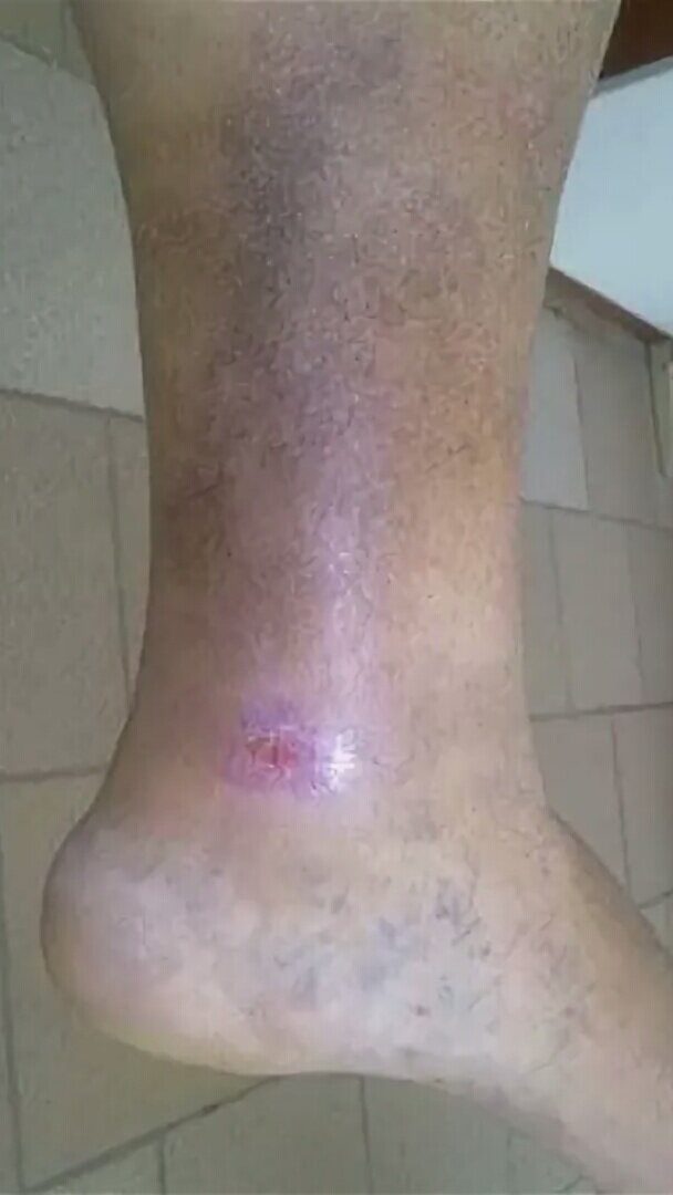 Трофическая язва