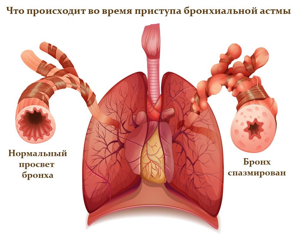 Иллюстрация бронхоспазма при астме