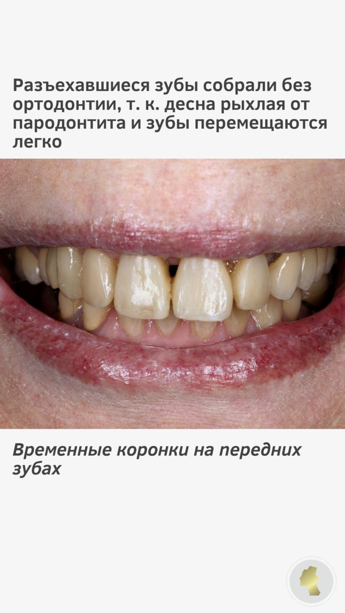 Парадонтит | Спасибо.Клиник | Дзен