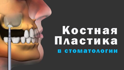 Виды костной пластика в стоматологии. После костной пластики