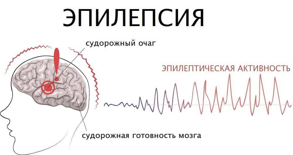 Патогенез эпилепсии картинки