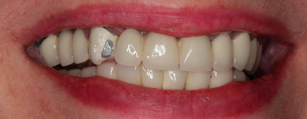 Можно ли починить металлокерамическую коронку, если от нее откололся ...