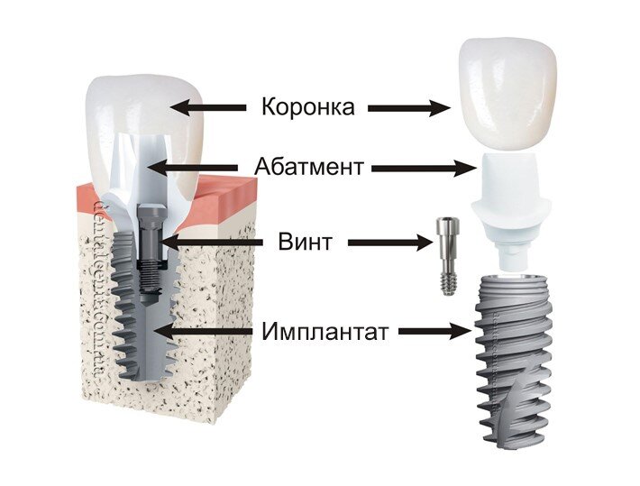 как крепится коронка на зуб