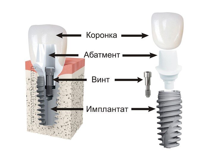 Этапы имплантации зубов схема