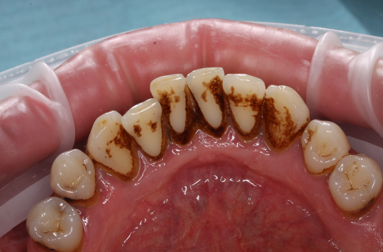 Зубной камень - налет курильщика. Фото сделано до профессиональной гигиены полости рта