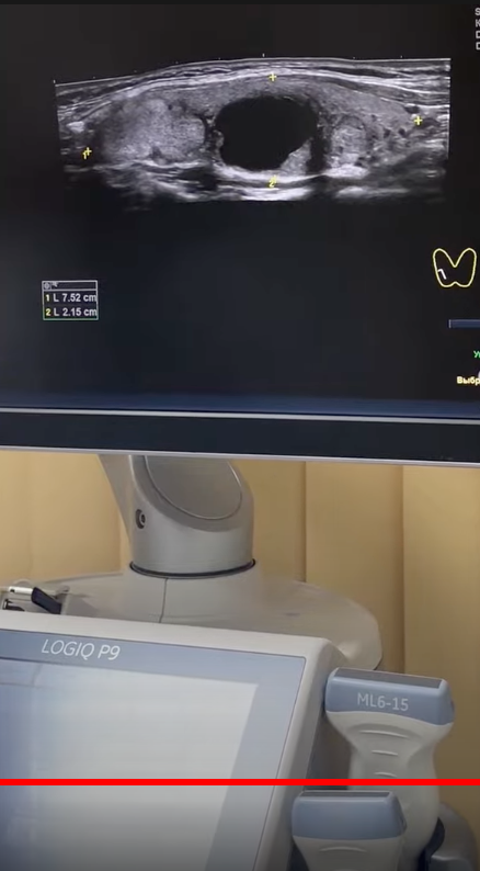 Кадр из нового фильма об УЗИ щитовидной железы