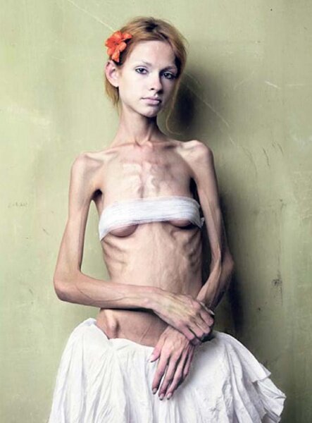 Смертельная западня анорексии