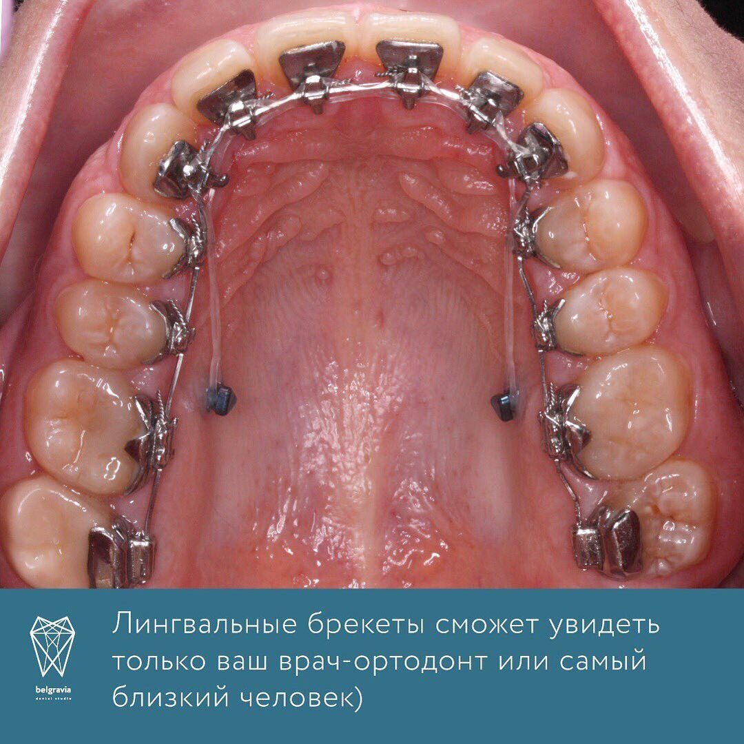 Брекеты-невидимки | Стоматология Belgravia Dental Studio | Дзен