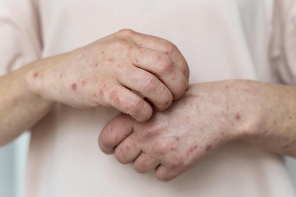    Роспотребнадзор рассказал о случаях подозрения на корь в Забайкалье