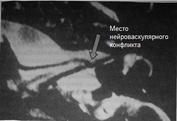 Нейроваскулярный конфликт при пароксизмии