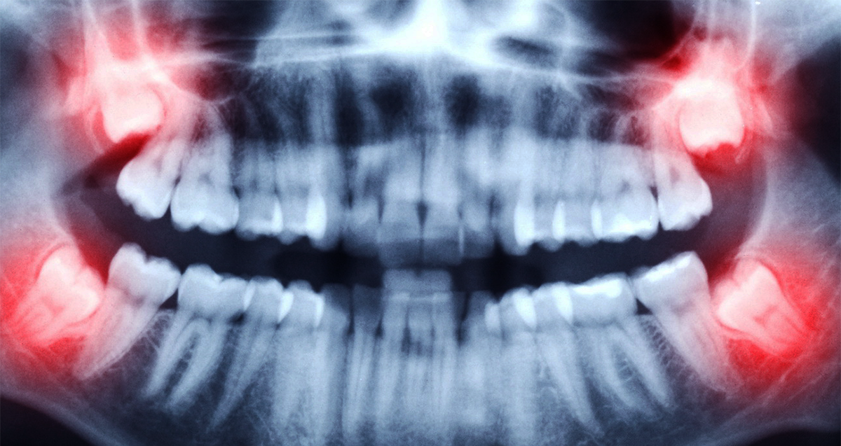 зубы мудрости