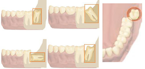 Правильный зуб мудрости фото