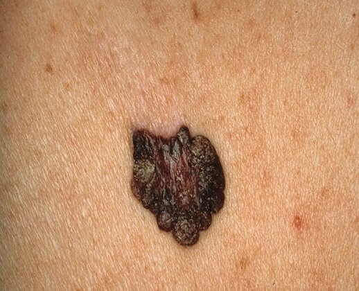 неправильная форма невуса, изменение цвета.