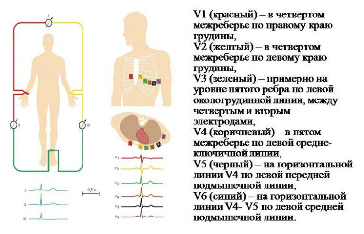 Экг наложение картинки