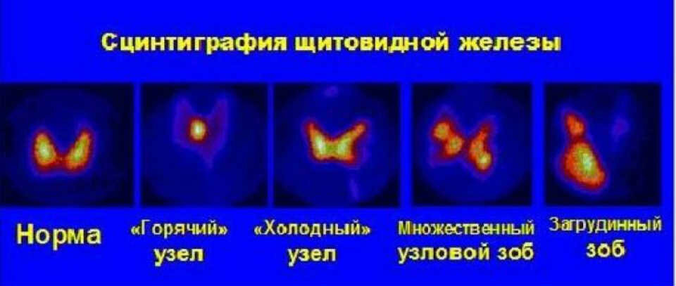 Зоб тест. Узловой токсический зоб сцинтиграфия. Радиоизотопный метод исследования щитовидной железы. Радионуклидное сканирование щитовидной железы. Токсическая аденома сцинтиграфия.