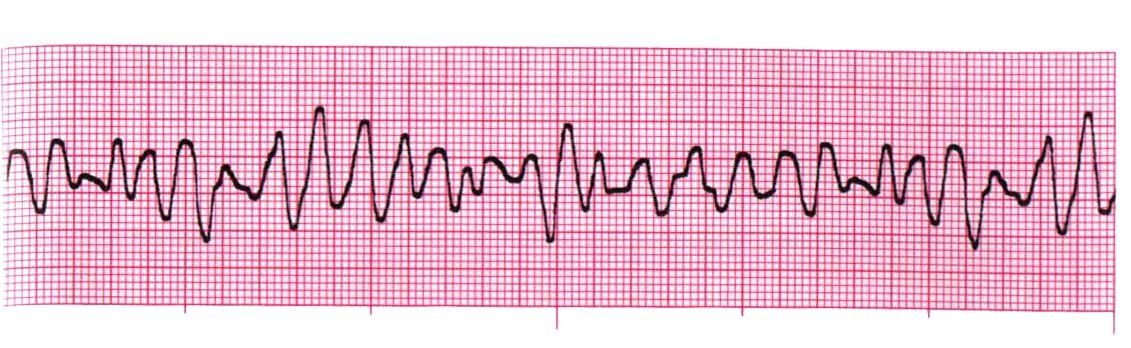 Фибрилляция желудочков на экг картинки