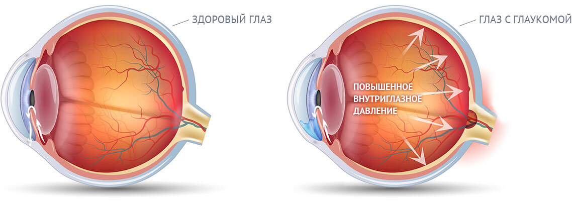 Клиническая картина глаукомы