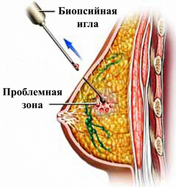 Лечение кисты молочной железы симптомы и диагностика | Медицинский дом Odrex