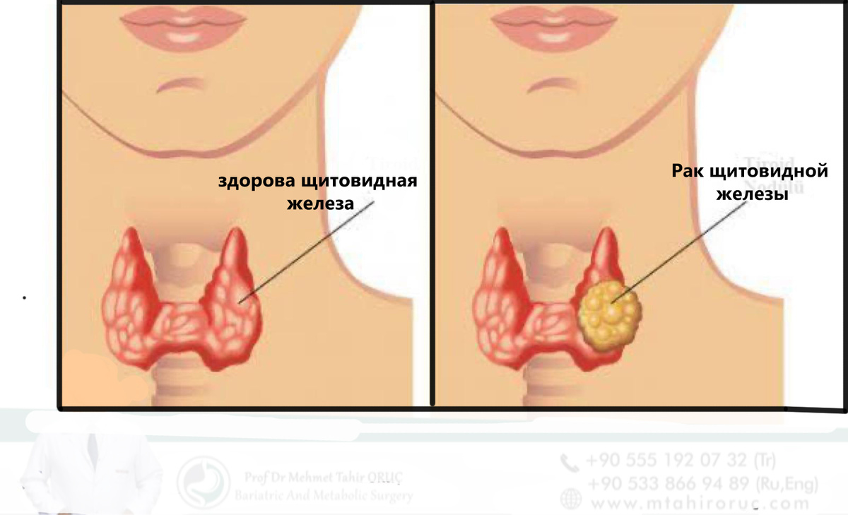 Здоровая  щитовидная железа (слева) и рак щитовидной железы (справа)