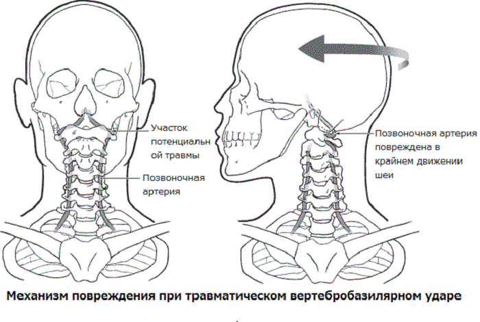 Синдром вертебробазилярной недостаточности