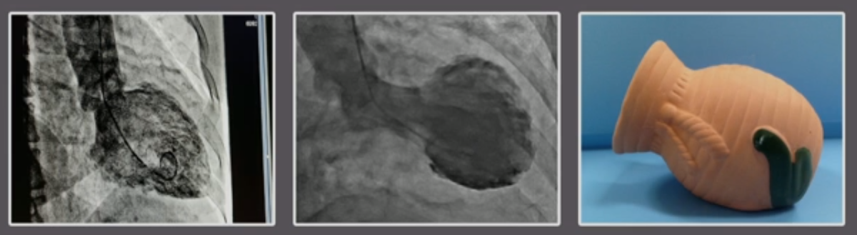                нормальное                                    деформированное                             такоцубо
